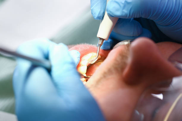 Best Emergency Treatment for Dental Infections or Abscesses in Marion, NC