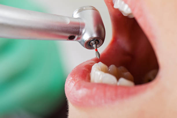 Best Emergency Treatment for Dental Infections or Abscesses in Marion, NC